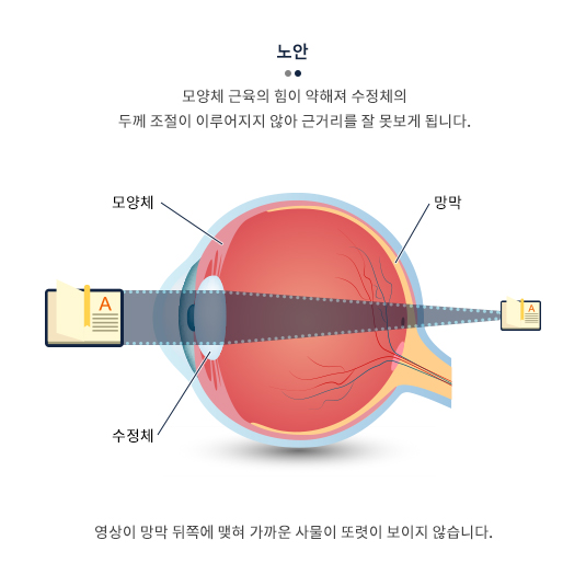 노안 모양체 근육의 힘이 약해져 수정체의 두께 조절이 이루어지지 않아 가까운 거리를 잘 못보게 됩니다. 영상이 망막 뒤쪽에 맺혀 가까운 사물이 또렸히 보이지 않습니다.