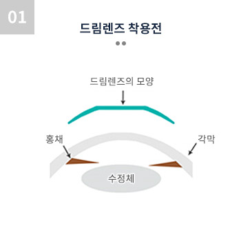 드림렌즈 착용전 드림렌즈의 모양