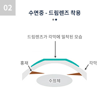 수면중 - 드림렌즈 착용 드림렌즈가 각막에 밀착된 모습