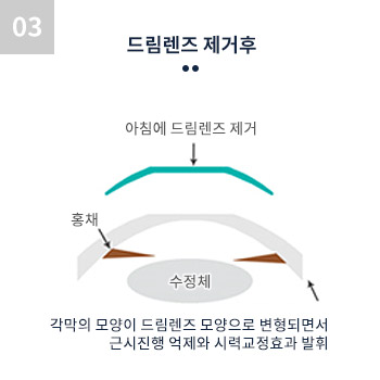 드림렌즈 제거후 아침에 드림렌즈 제거