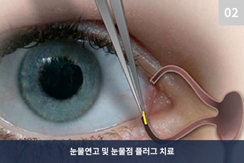 눈물연고 및 눈물점 플러그 치료