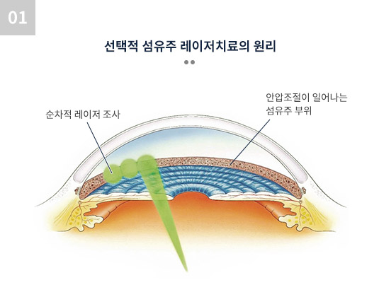 선택적 섬유주 레이저치료의 원리 순차적 레이저 조사 안압조절이 일어나는 섬유주 부위