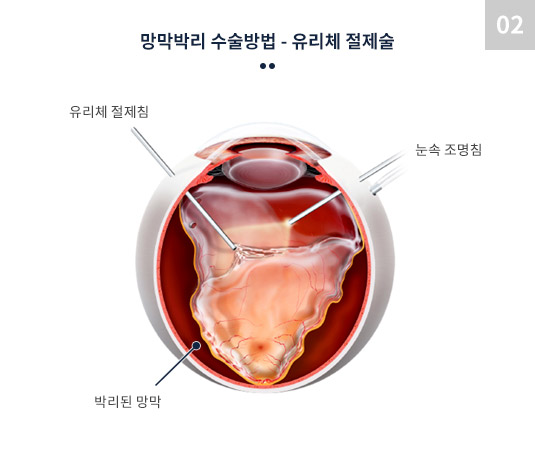 망막박리 수술방법 - 유리체 절제술