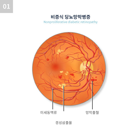 비증식 당뇨망막병증