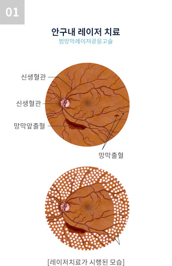 안구내 레이저 치료 범망막레이저광응고술