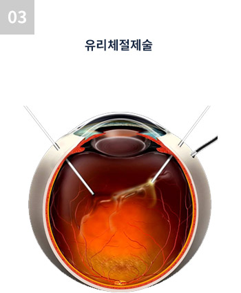 유리체절제술