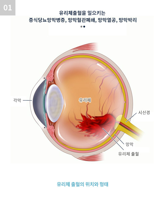 유리체출혈을 일으키는 증식당뇨망막병증, 망막혈관폐쇄, 망막열공, 망막박리