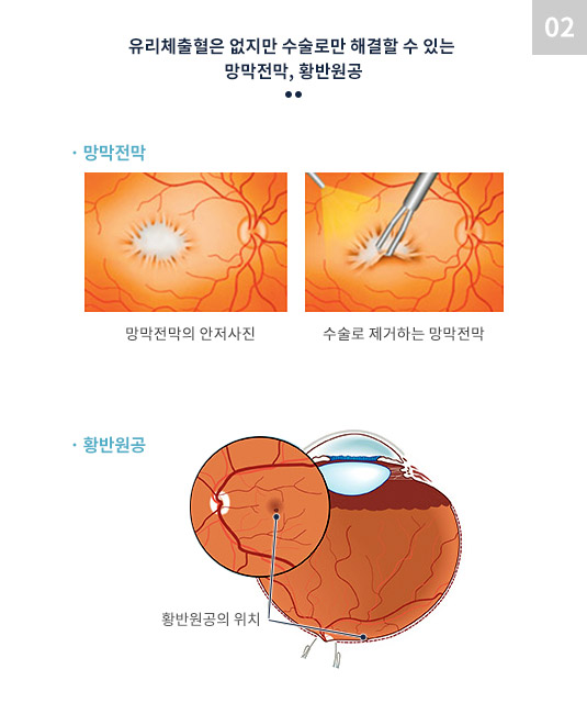 유리체출혈은 없지만 수술로만 해결할 수 있는 망막전막, 황반원공